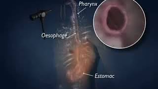 5 Endoscopie fibroscopie oeso gastro duodénale ou di [upl. by Ahselrac]