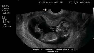 Comment se déroule l’échographie du 2eme trimestre   Echographie morphologique [upl. by Thurmann]