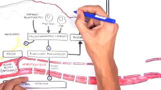 Burns Classification and Treatment – CIMS Hospital [upl. by Hatti968]