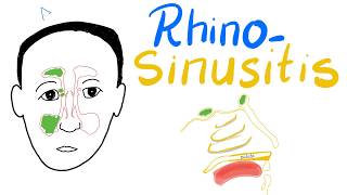 Rhinosinusitis Acuteamp Chronic Clinical Picture Diagnosisamp Management  Cases [upl. by Atyekram]