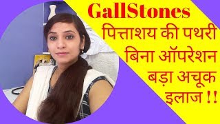 Gallstones symptoms amp homeopathic treatment  gallbladder stones symptoms amp homeopathic medicine [upl. by Annoyk470]