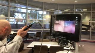 Video laryngoscopy assisted fiberoptic intubation [upl. by Nnyleve]