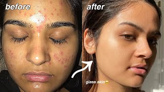 how i cleared my acne FOR GOOD something finally worked [upl. by Odnalra]