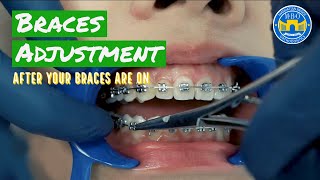 How Do Braces Straighten Teeth [upl. by Odnalref692]