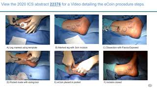 3 PIVOTAL STUDY OF SUBCUTANEOUS TIBIAL NERVE STIMULATION WITH COINSIZED IMPLANTABLE TIBIAL NEU [upl. by Abbie]