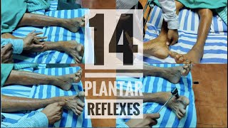 14 Abnormal plantar reflexes Babinski equivalents [upl. by Hcir567]