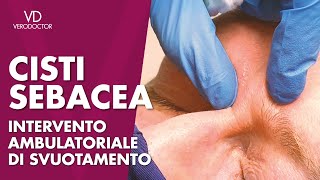 CISTI SEBACEA intervento ambulatoriale di svuotamento [upl. by Rockwell]