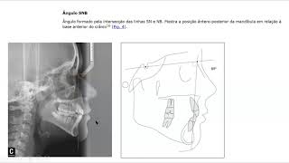 Aula de Cefalometria [upl. by Irehc]