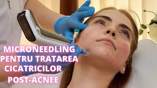 Microneedling Dermapen pentru tratarea cicatricilor postacnee  DermaBeauty Clinique [upl. by Slocum]