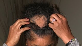 Hair Care Routine How to stop shedding and hair loss  Dr Shereene Idriss [upl. by Hiett]