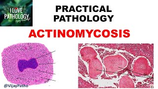 Practical Pathology ACTINOMYCOSIS [upl. by Berthe]