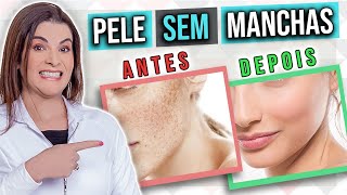 5 Melhores ÁCIDOS que Você Deve Usar Para Clarear Manchas na Pele [upl. by Duwad]