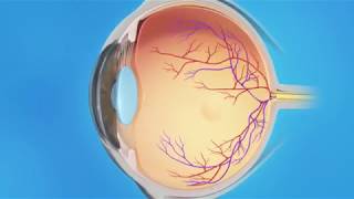 Detached Retina Pneumatic Retinopexy [upl. by D'Arcy]