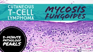 Mycosis Fungoides Cutaneous TCell Lymphoma 5Minute Pathology Pearls [upl. by Erin848]