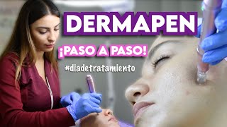 DERMAPEN  TRATAMIENTO DE MICRONEEDLING  Ximena Ramaya [upl. by Hakilam807]