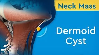 Neck Cyst Dr Khaled Sadek [upl. by Alber43]