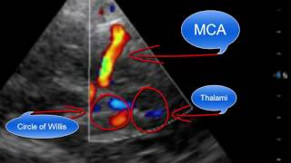 Pointofcare Transcranial Doppler [upl. by Uwton439]