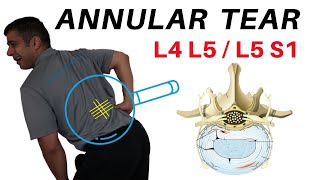 Annular Tear L4L5 L5S1 Disc Bulges [upl. by Llehsar]