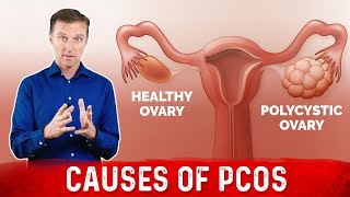 Natural way to treat Polycystic ovarian syndrome PCOSPCOD  Dr Vivek Joshi [upl. by Siram]