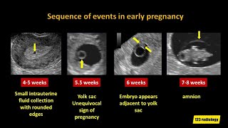 Early Pregnancy Failure A simplified Ultrasound Approach [upl. by Itak]