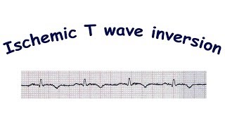 Mechanism of ischemic T wave inversion [upl. by Gula121]