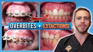 Braces Overbite Treatment BEFORE amp AFTER [upl. by Richey]