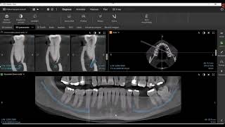 DTX Studio™ Clinic Featuring MagicAssist Nerve Mapping [upl. by Sibby210]