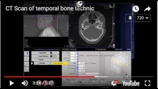 CT Scan of temporal bone technic [upl. by Warfield]