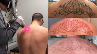 Laser Tattoo Removal  The Ugly Truth [upl. by Arbma619]