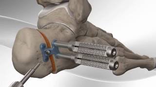 Flatfoot Repair with Arthrex® Calcaneus Step Plate [upl. by Ymassej]