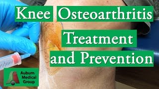 Knee Osteoarthritis Treatment and Prevention  Auburn Medical Group [upl. by Ecissej]