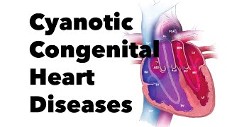 Cyanotic Congenital Heart Diseases  MEDZCOOL [upl. by Amie241]