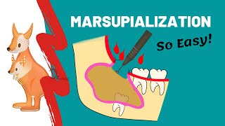 Marsupialization  WHEN WHY amp HOW [upl. by Anorahs966]