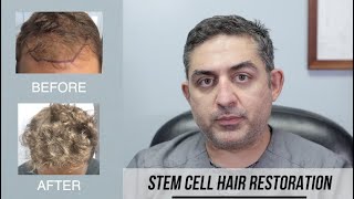 Stem Cell Hair Restoration Success Story [upl. by Augusto271]