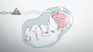 What is hypoxic ischemic encephalopathy [upl. by Nemzzaj]