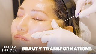 How Nonsurgical FaceLifts Work With PDO Threads  Beauty Transformations  Insider Beauty [upl. by Coumas205]