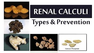 Renal Calculi Types and Prevention [upl. by Ailyn]