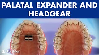 Orthodontic devices  Palatal expander and headgear © [upl. by Navets]