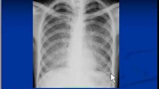 Chest xray interpretation  Miliary Tuberculosis [upl. by Eardna]