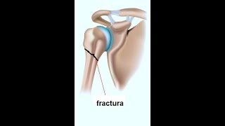 Fisioterapia quotFractura de Humeroquot [upl. by Eadith]