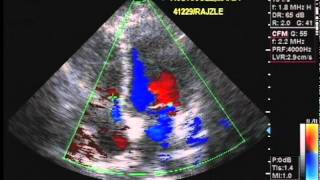 Echocardiography and Color Flow Doppler [upl. by Lotte]