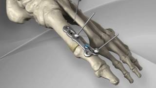 First Metatarsophalangeal Joint Fusion with Arthrex® MTP Fusion Plate [upl. by Wolgast]