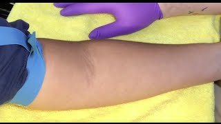 Tips For Locating Difficult Veins [upl. by Anilorac]