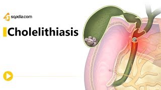 Cholelithiasis II  Gastroenterology Medicine Animation  Medical VLearning [upl. by Akirdnuhs]