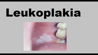 Leukoplakia [upl. by Elfont]