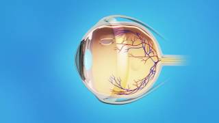 Retinal Detachment Surgery  What To Expect During Recovery [upl. by Imas]