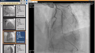 The Basics of Coronary CT Angiography [upl. by Gnak174]