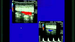 ECOGRAFIA DOPPLER ARTERIAL PERIFERICO [upl. by Pollie155]